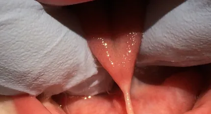 Frenectomy (Tongue-Tie Correction)